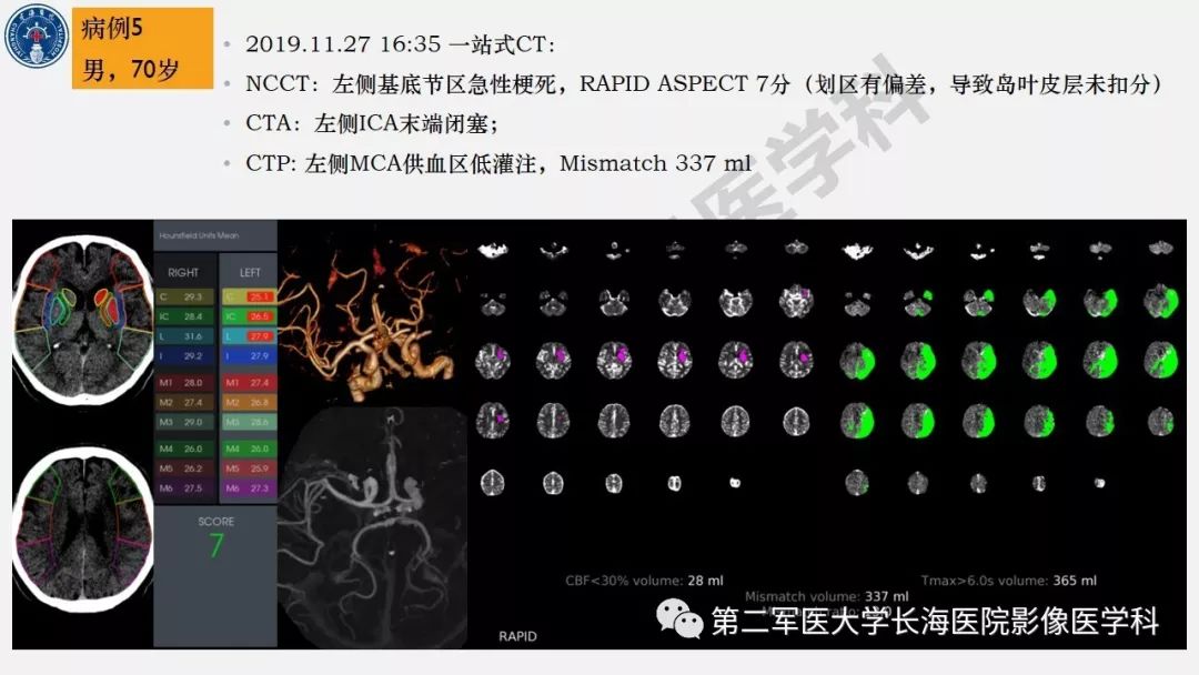 【PPT】2019中国《急性缺血性脑血管病影像指导规范》解读