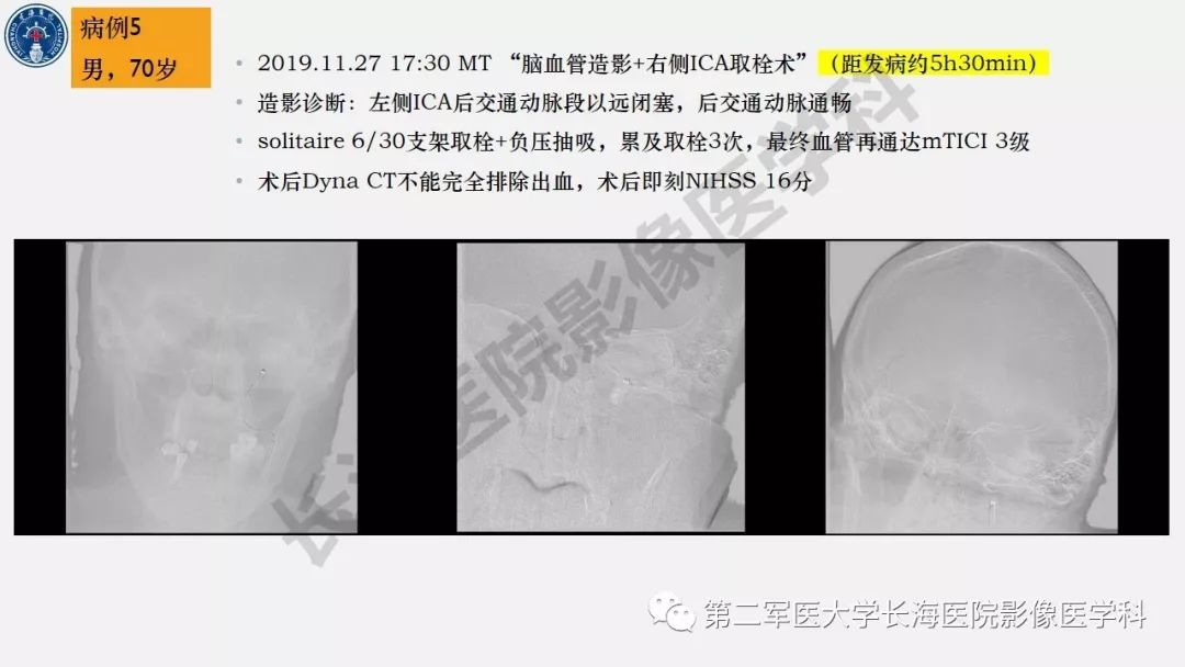 【PPT】2019中国《急性缺血性脑血管病影像指导规范》解读