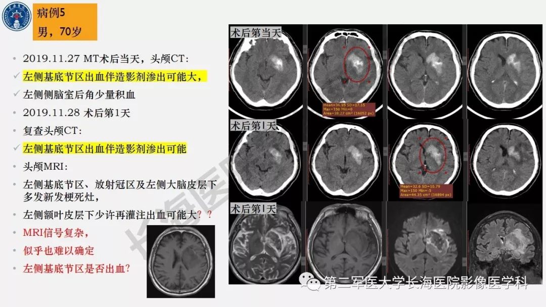 【PPT】2019中国《急性缺血性脑血管病影像指导规范》解读