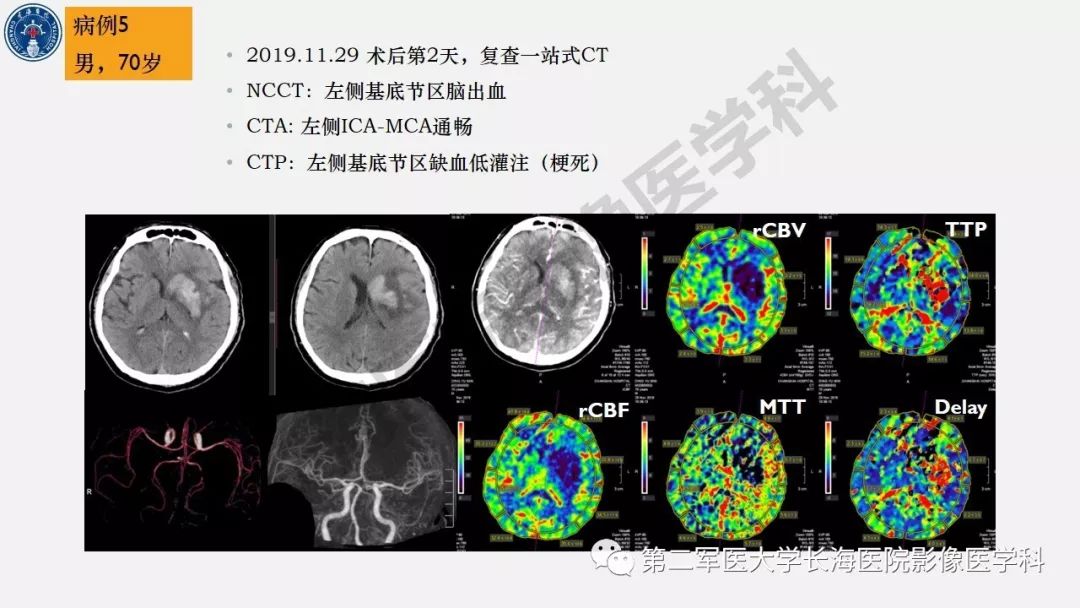 【PPT】2019中国《急性缺血性脑血管病影像指导规范》解读