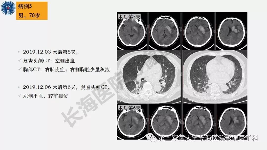 【PPT】2019中国《急性缺血性脑血管病影像指导规范》解读