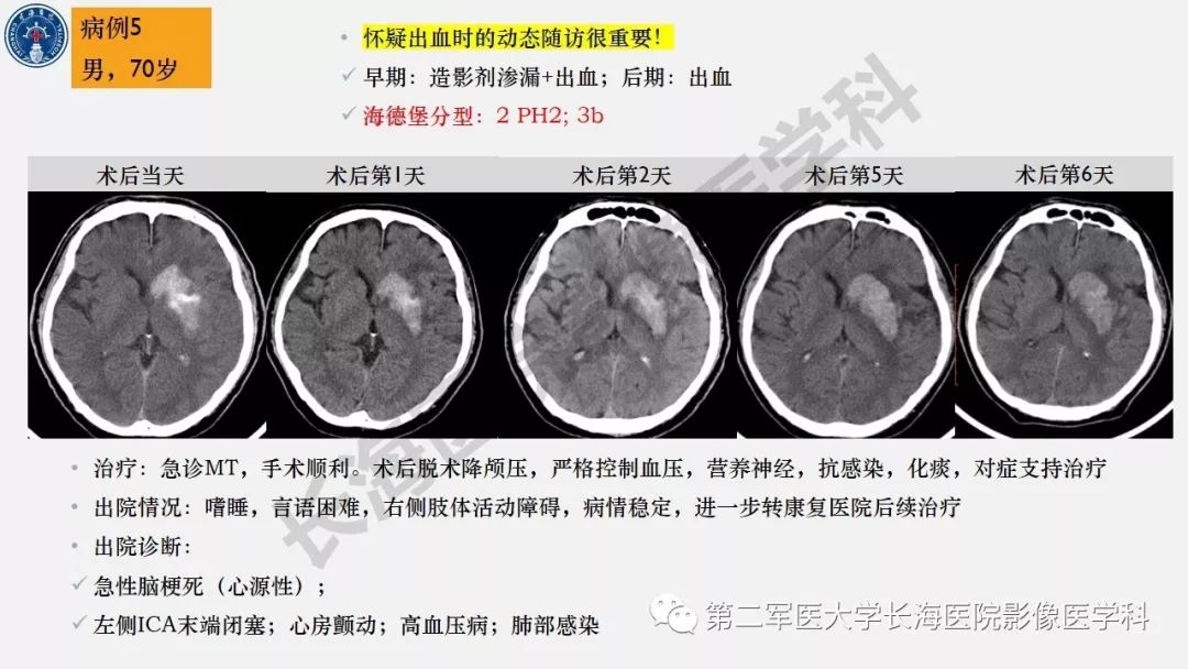 【PPT】2019中国《急性缺血性脑血管病影像指导规范》解读