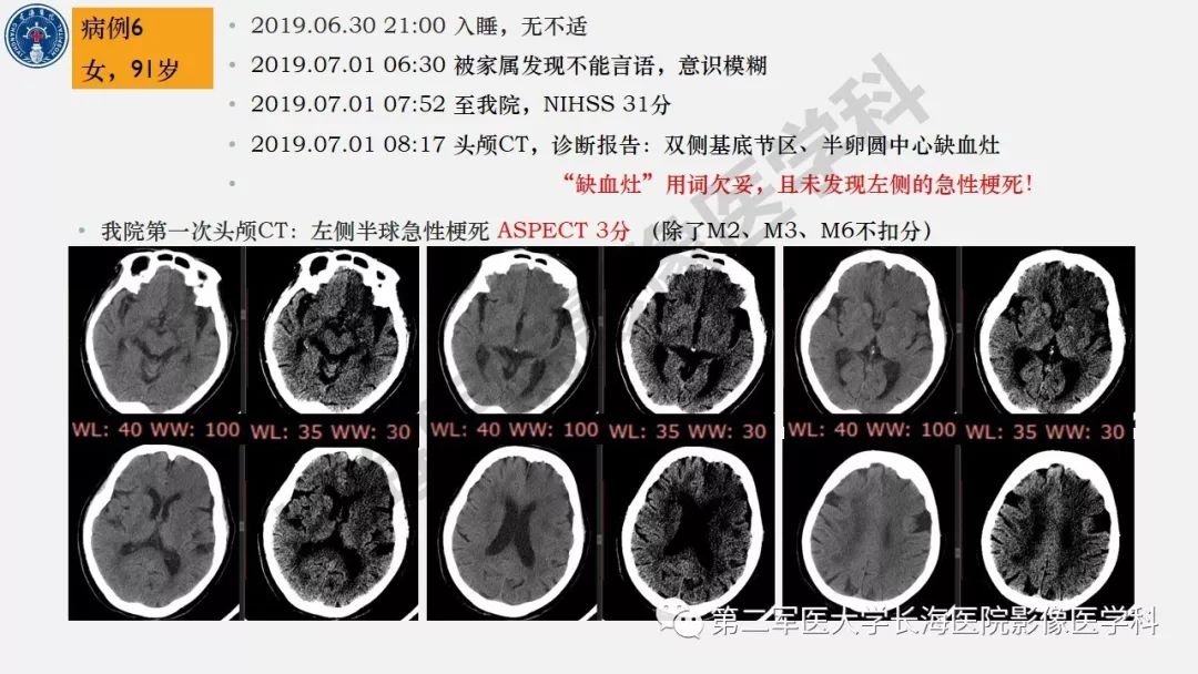 【PPT】2019中国《急性缺血性脑血管病影像指导规范》解读