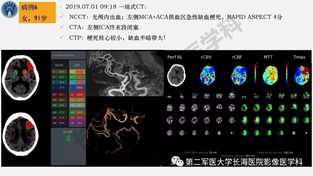 【PPT】2019中国《急性缺血性脑血管病影像指导规范》解读