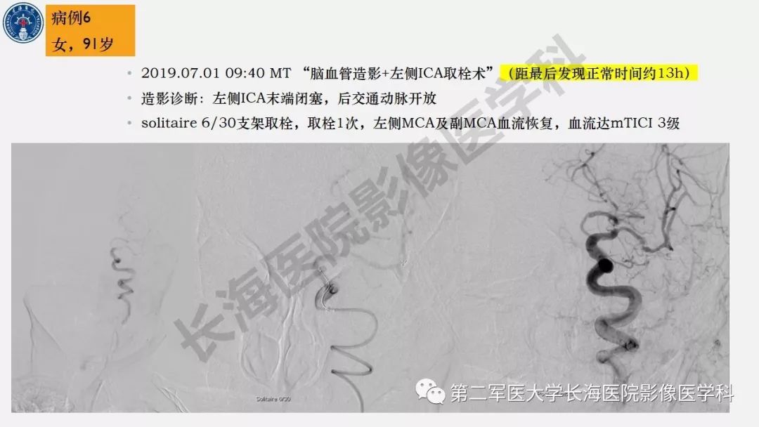 【PPT】2019中国《急性缺血性脑血管病影像指导规范》解读