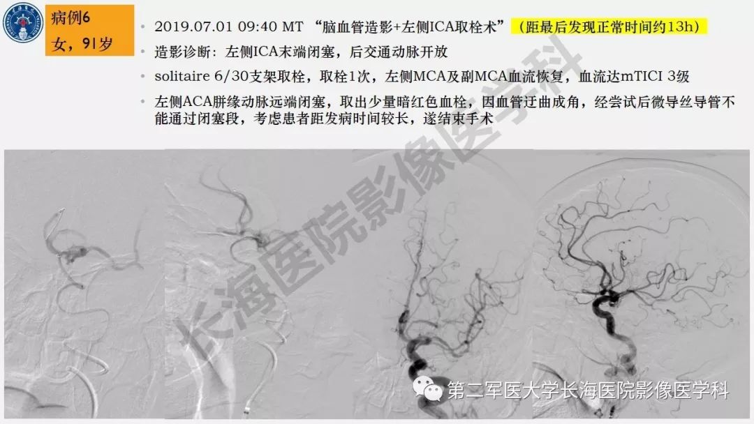 【PPT】2019中国《急性缺血性脑血管病影像指导规范》解读
