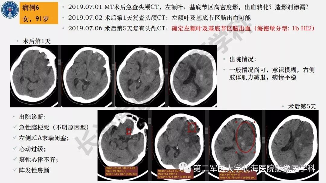 【PPT】2019中国《急性缺血性脑血管病影像指导规范》解读