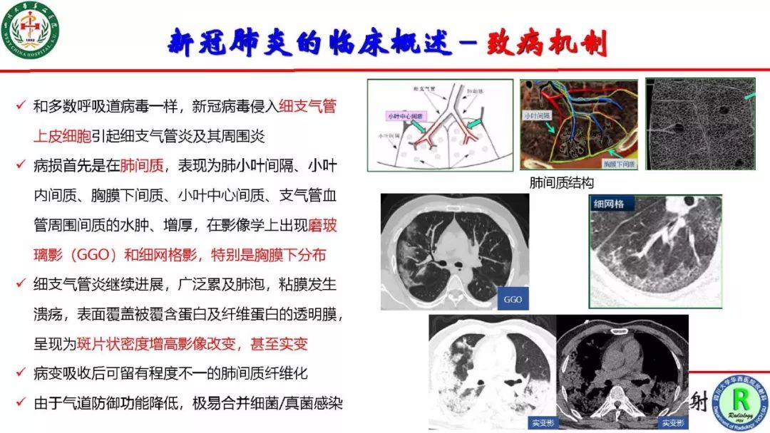 【PPT】影像学在抗击新型冠状病毒肺炎战“疫”中的价值