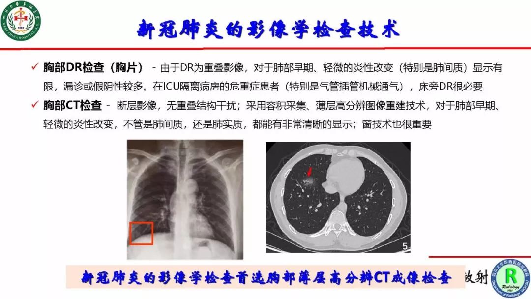【PPT】影像学在抗击新型冠状病毒肺炎战“疫”中的价值