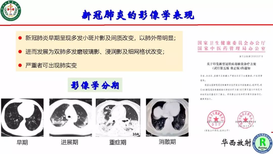 【PPT】影像学在抗击新型冠状病毒肺炎战“疫”中的价值