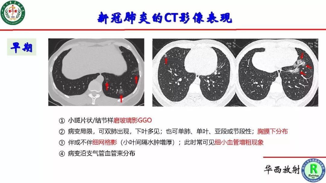 【PPT】影像学在抗击新型冠状病毒肺炎战“疫”中的价值