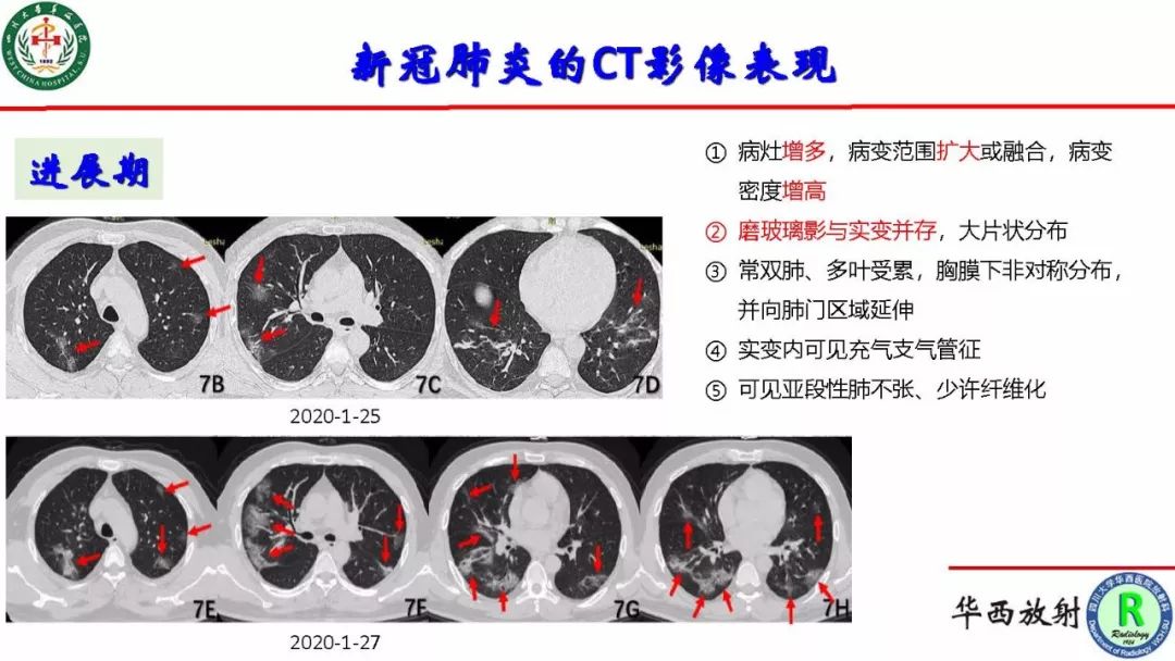 【PPT】影像学在抗击新型冠状病毒肺炎战“疫”中的价值