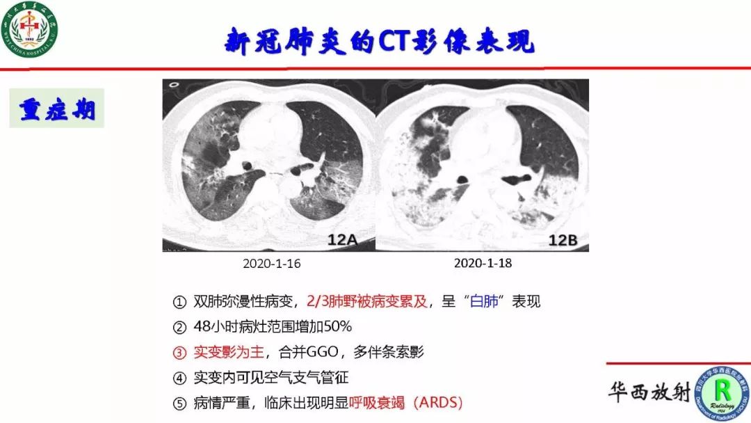 【PPT】影像学在抗击新型冠状病毒肺炎战“疫”中的价值