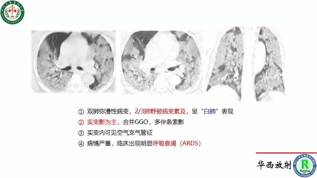 【PPT】影像学在抗击新型冠状病毒肺炎战“疫”中的价值