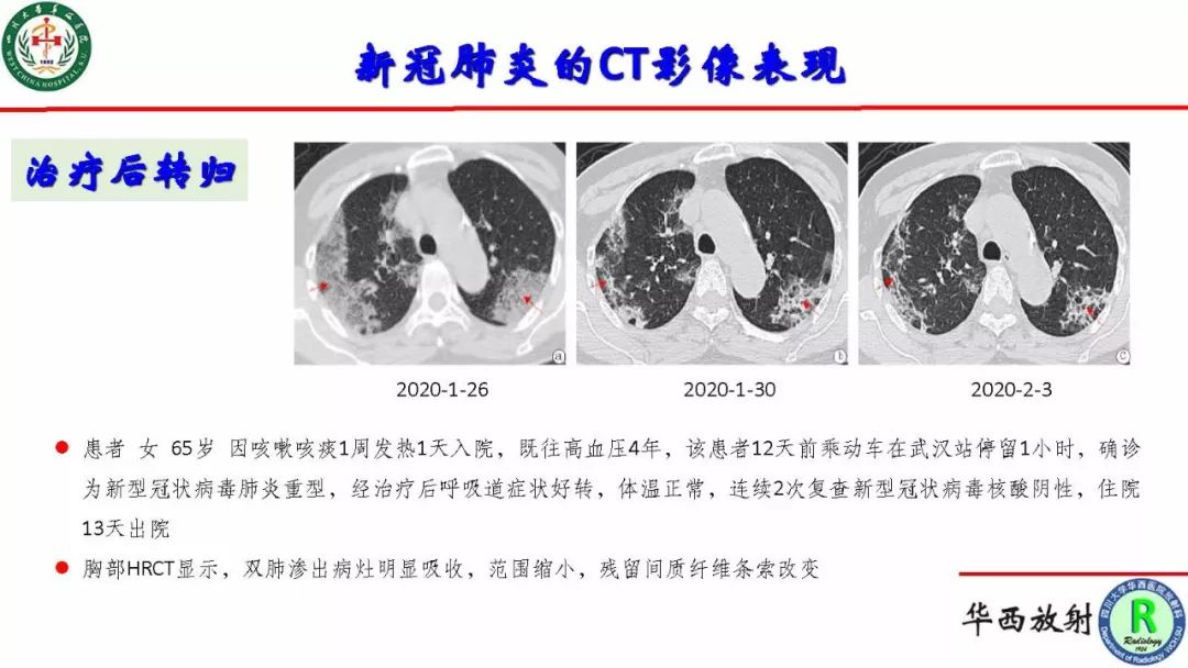 【PPT】影像学在抗击新型冠状病毒肺炎战“疫”中的价值