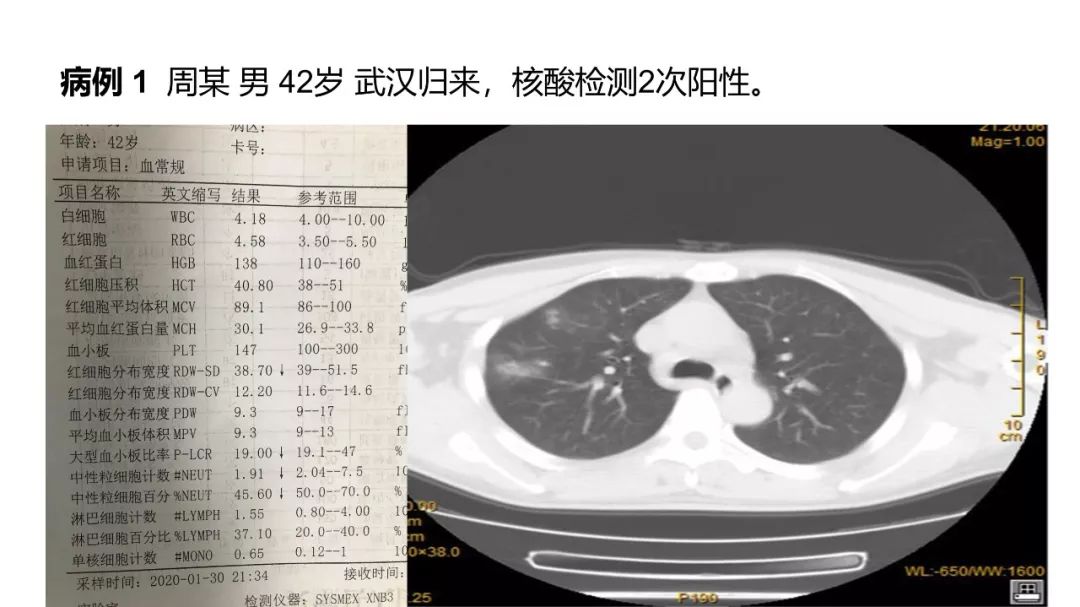 【PPT】6例新型冠状病毒肺炎CT影像表现