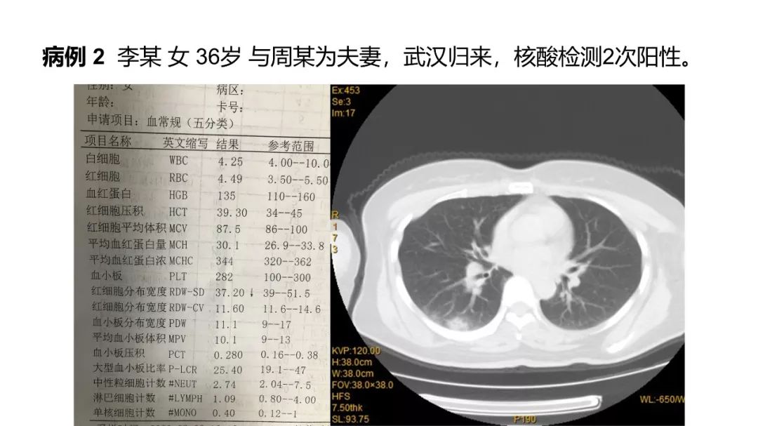 【PPT】6例新型冠状病毒肺炎CT影像表现