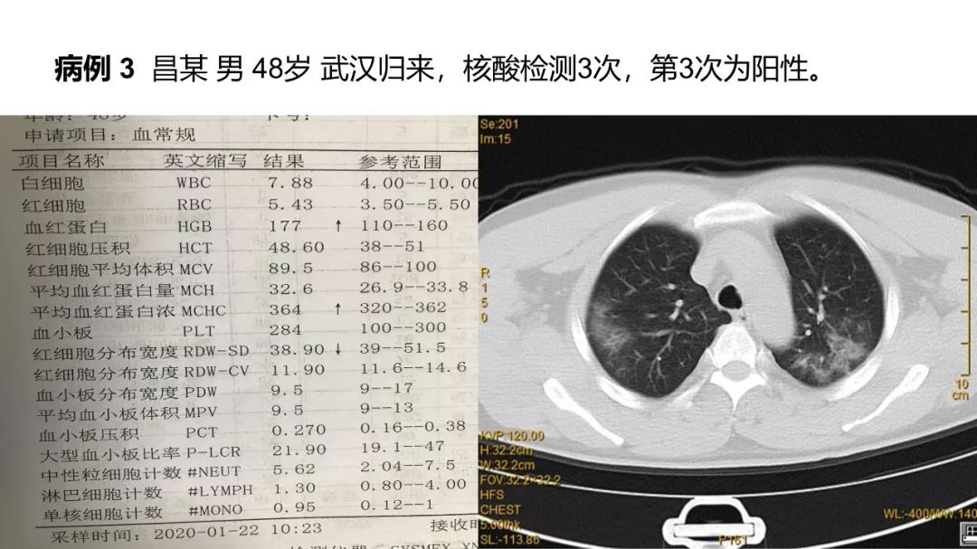 【PPT】6例新型冠状病毒肺炎CT影像表现