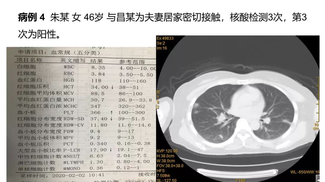 【PPT】6例新型冠状病毒肺炎CT影像表现