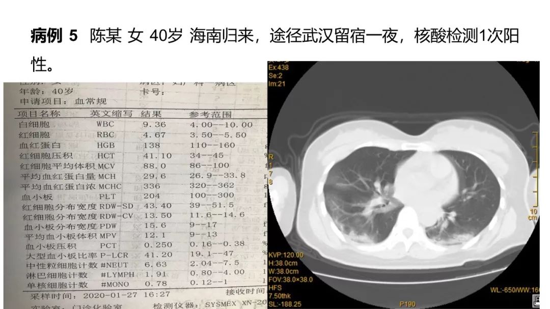 【PPT】6例新型冠状病毒肺炎CT影像表现