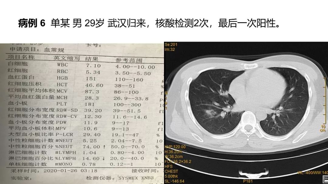 【PPT】6例新型冠状病毒肺炎CT影像表现