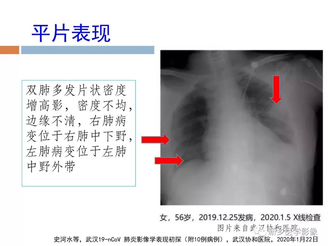 【PPT】2019新型冠状病毒肺炎影像学表现