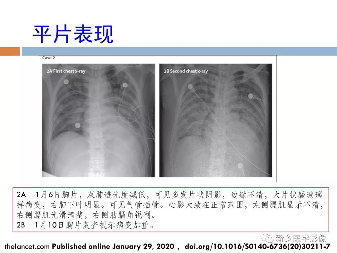 【PPT】2019新型冠状病毒肺炎影像学表现