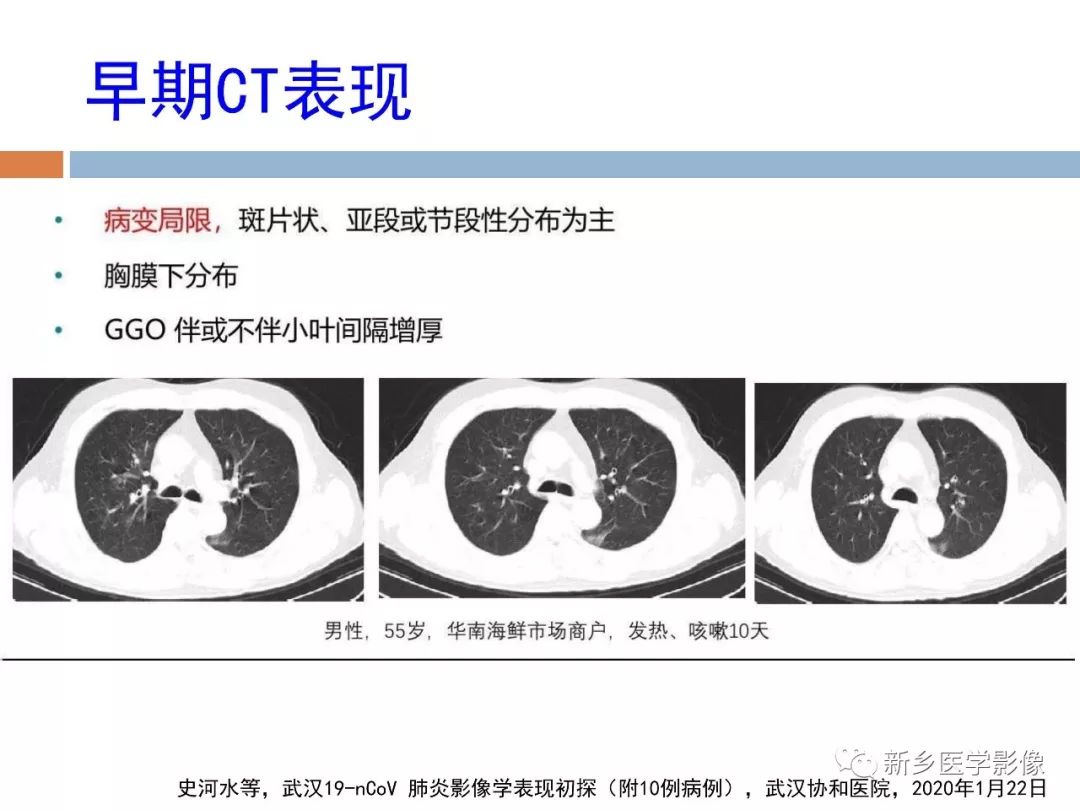 【PPT】2019新型冠状病毒肺炎影像学表现