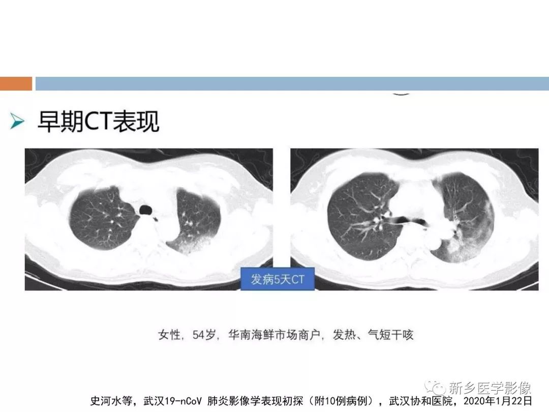 【PPT】2019新型冠状病毒肺炎影像学表现