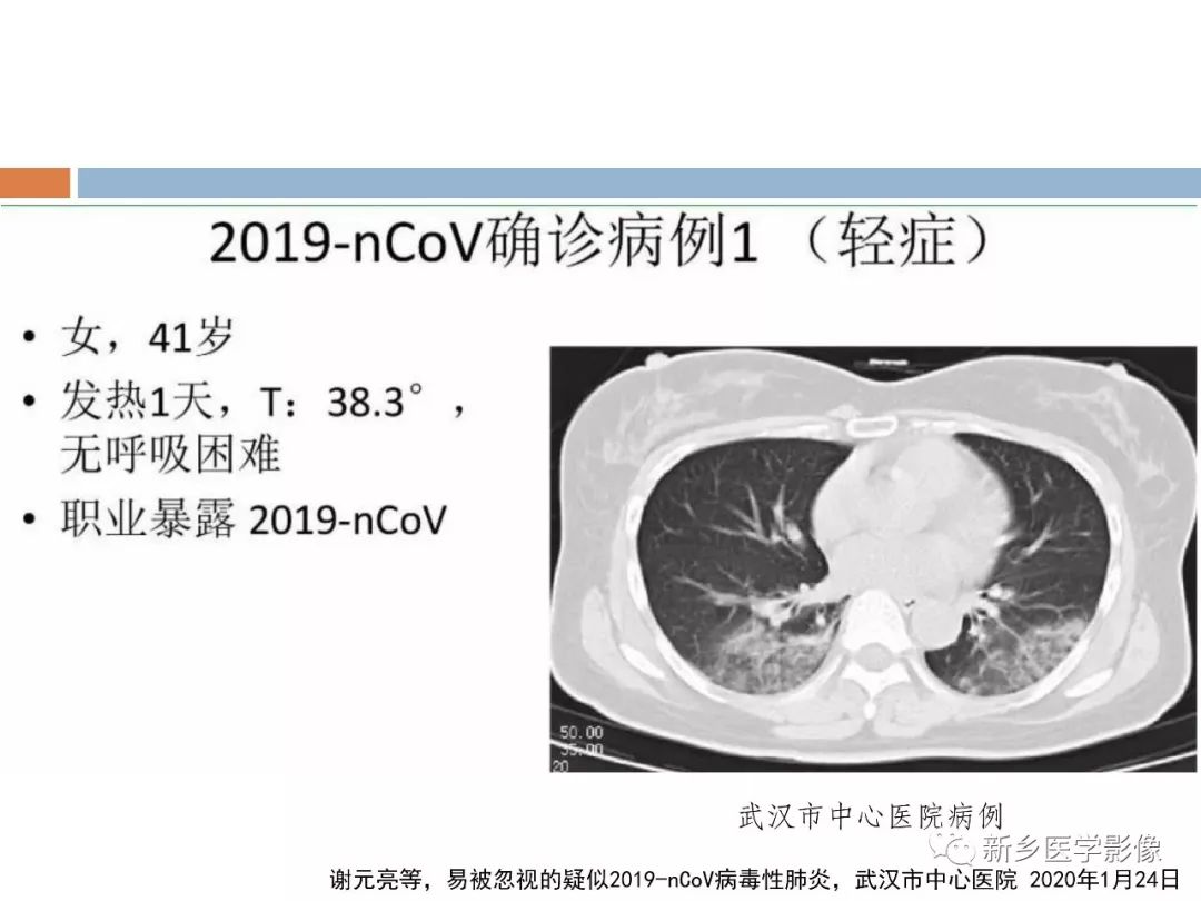 【PPT】2019新型冠状病毒肺炎影像学表现