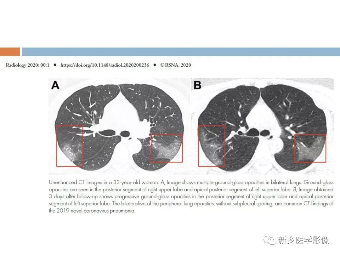【PPT】2019新型冠状病毒肺炎影像学表现