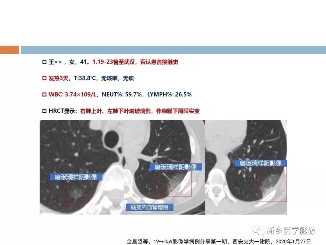 【PPT】2019新型冠状病毒肺炎影像学表现