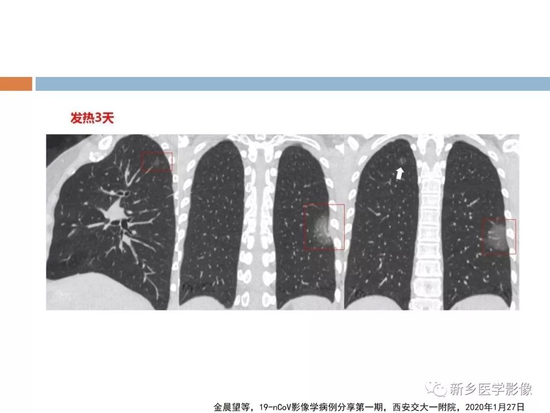 【PPT】2019新型冠状病毒肺炎影像学表现