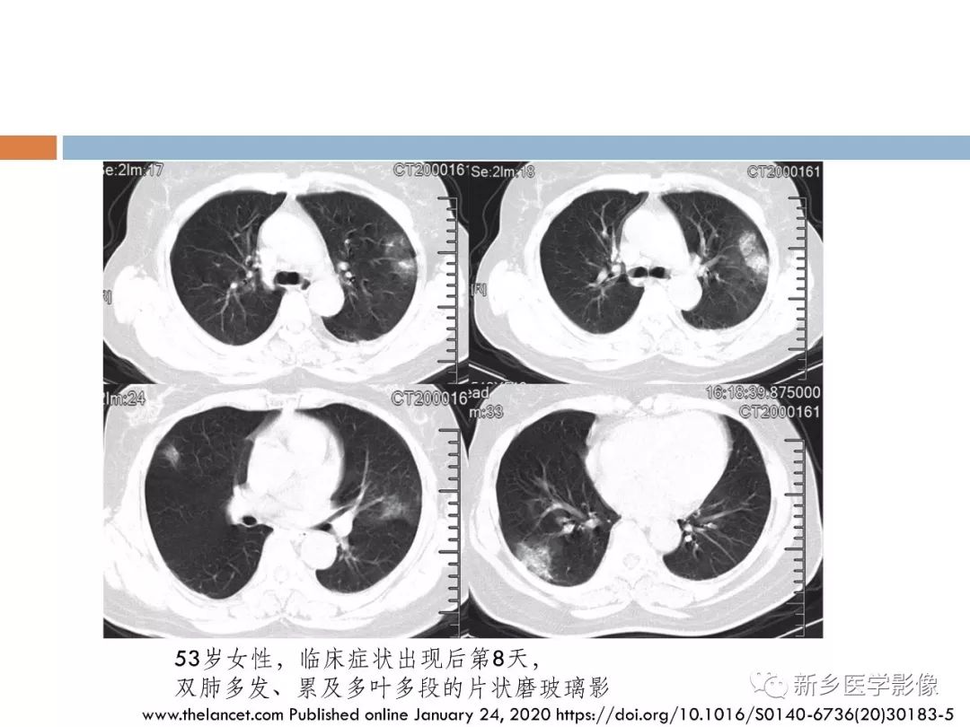 【PPT】2019新型冠状病毒肺炎影像学表现