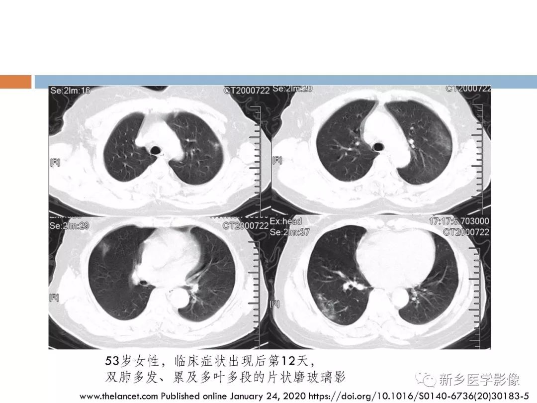 【PPT】2019新型冠状病毒肺炎影像学表现