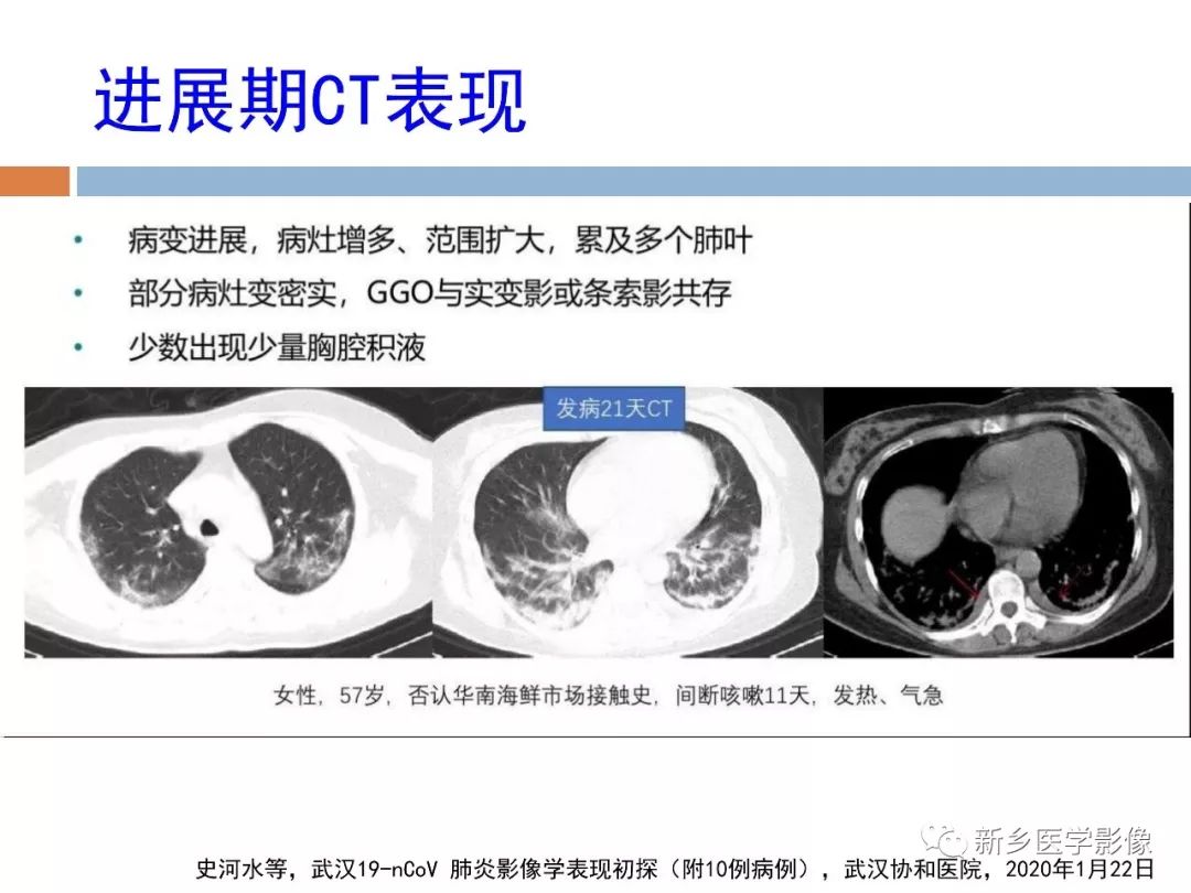 【PPT】2019新型冠状病毒肺炎影像学表现