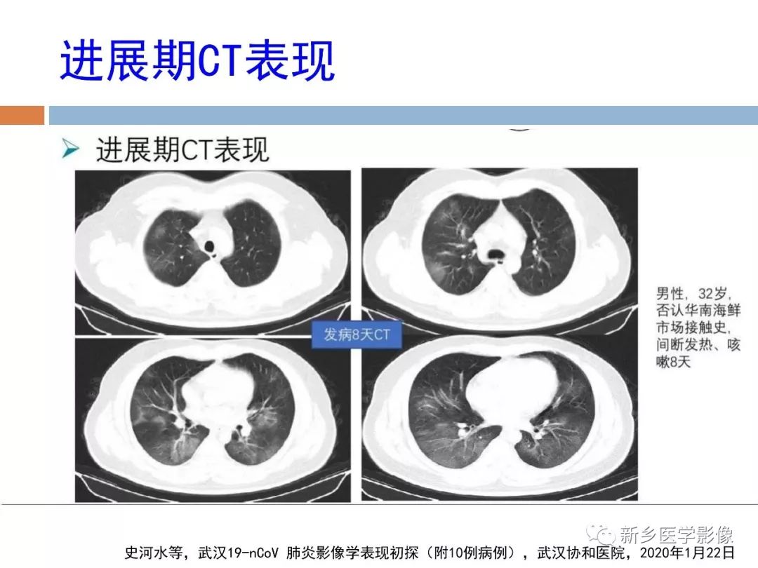 【PPT】2019新型冠状病毒肺炎影像学表现
