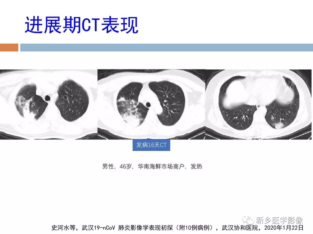 【PPT】2019新型冠状病毒肺炎影像学表现