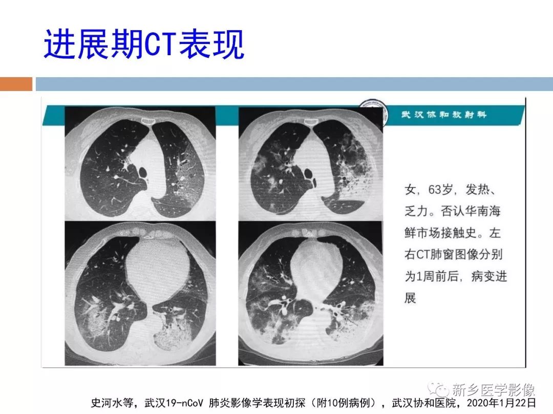 【PPT】2019新型冠状病毒肺炎影像学表现