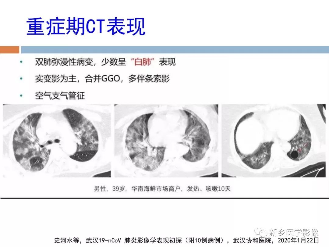 【PPT】2019新型冠状病毒肺炎影像学表现