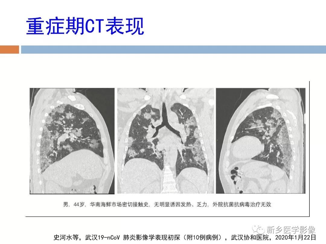 【PPT】2019新型冠状病毒肺炎影像学表现