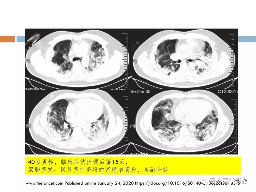 【PPT】2019新型冠状病毒肺炎影像学表现