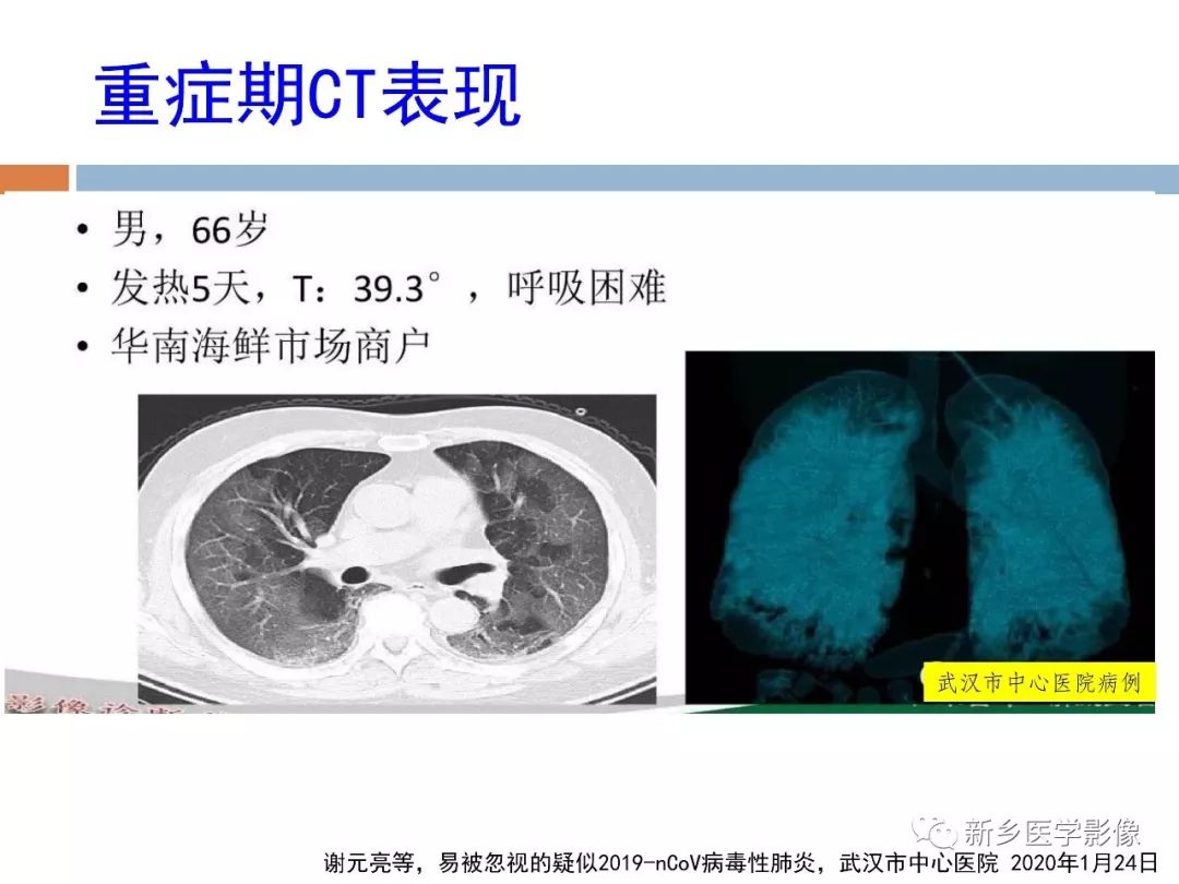 【PPT】2019新型冠状病毒肺炎影像学表现
