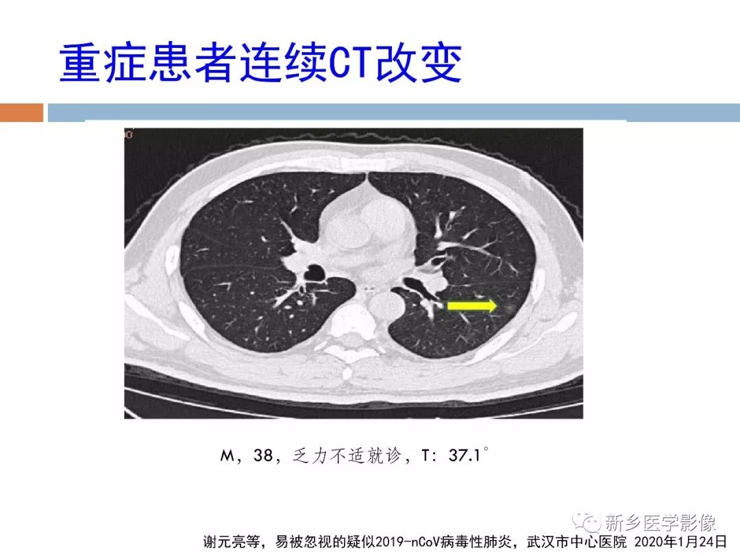 【PPT】2019新型冠状病毒肺炎影像学表现