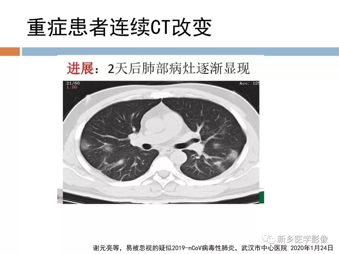 【PPT】2019新型冠状病毒肺炎影像学表现