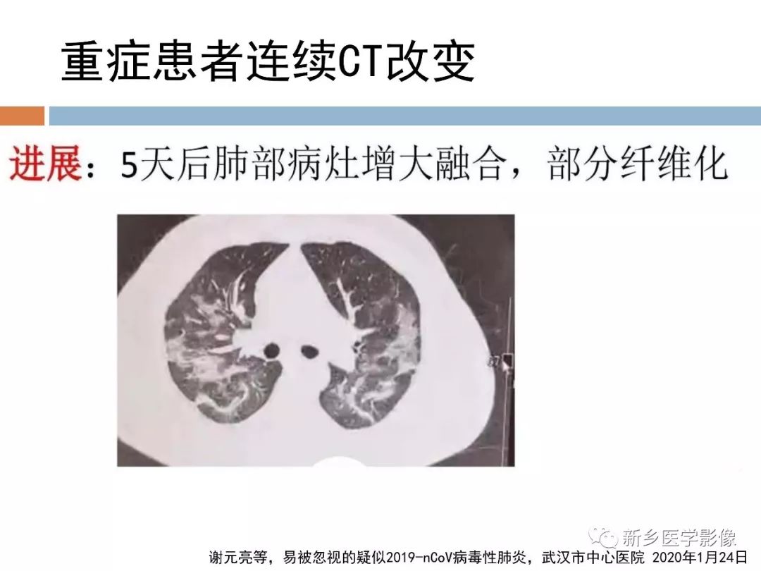 【PPT】2019新型冠状病毒肺炎影像学表现