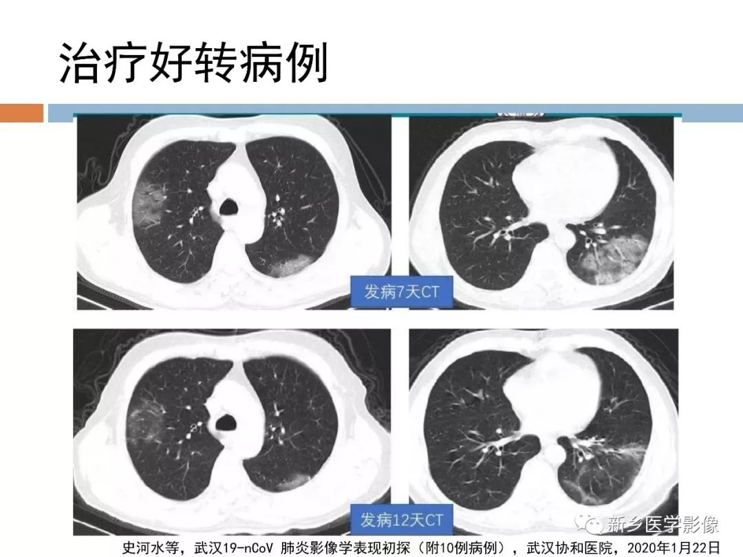 【PPT】2019新型冠状病毒肺炎影像学表现