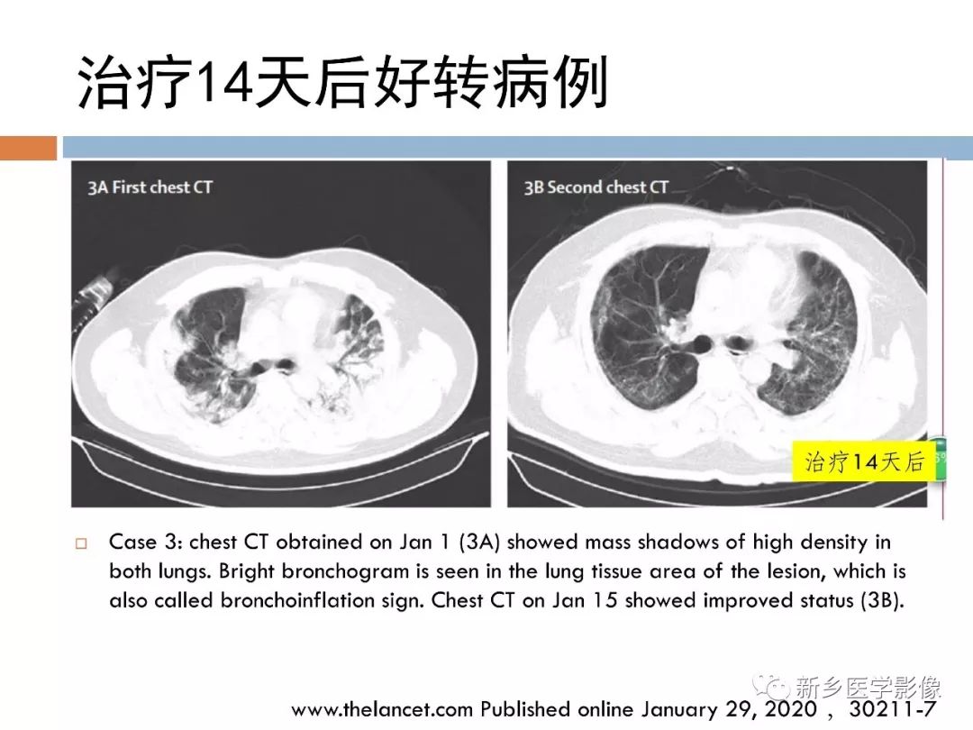 【PPT】2019新型冠状病毒肺炎影像学表现