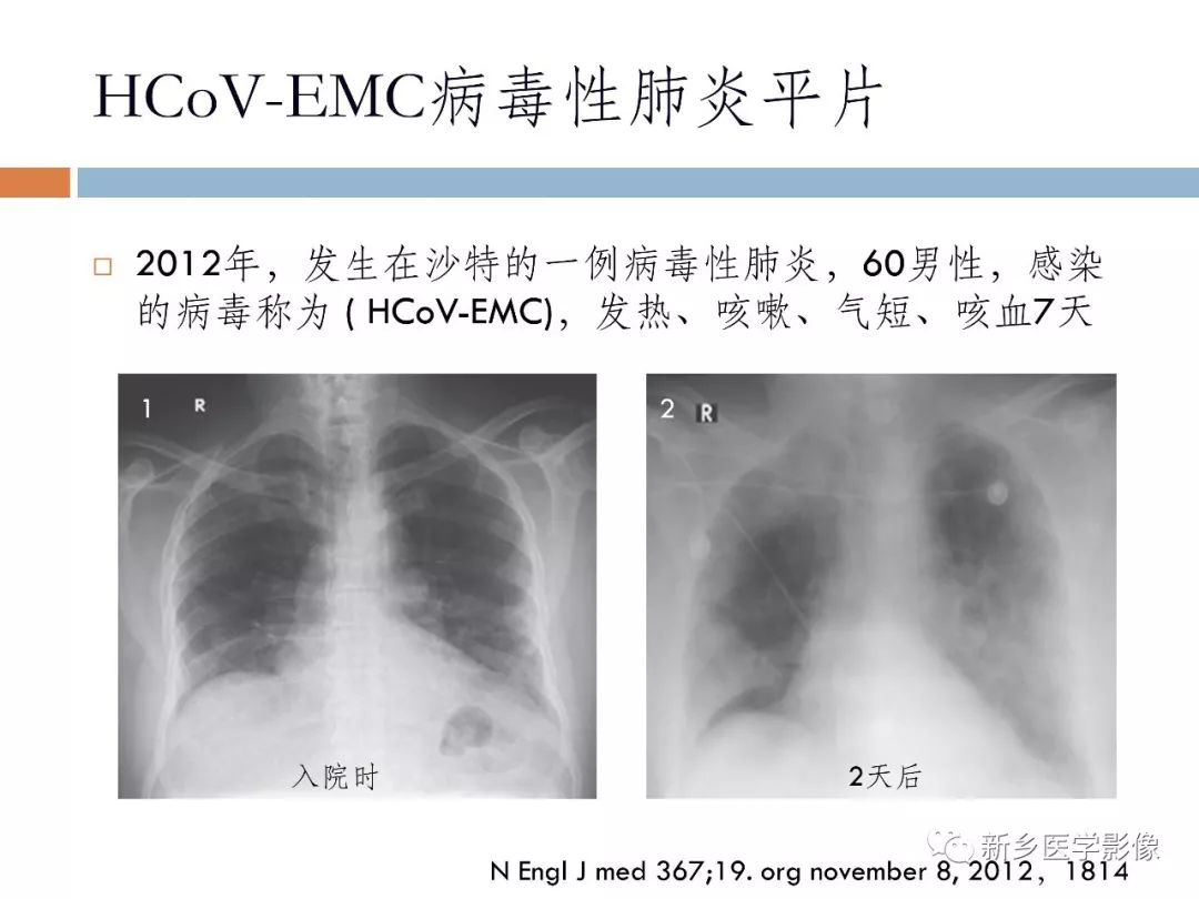 【PPT】2019新型冠状病毒肺炎影像学表现