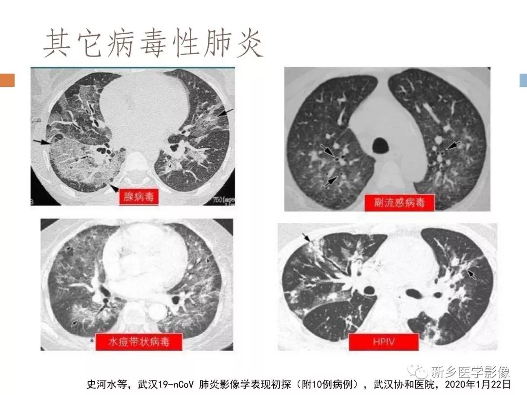 【PPT】2019新型冠状病毒肺炎影像学表现